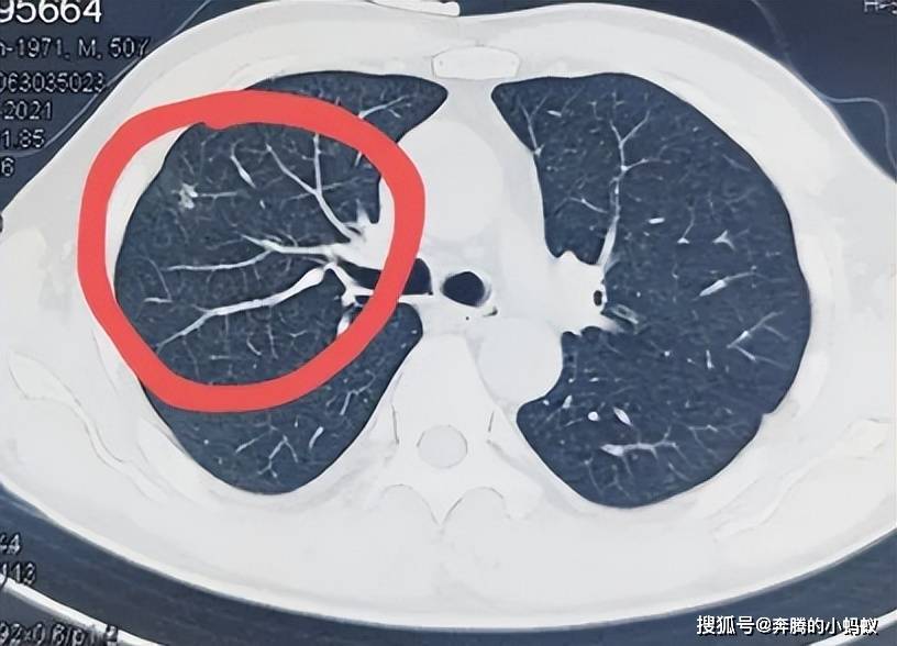 13毫米的肺结节，是肺癌的征兆还是偶然发现？